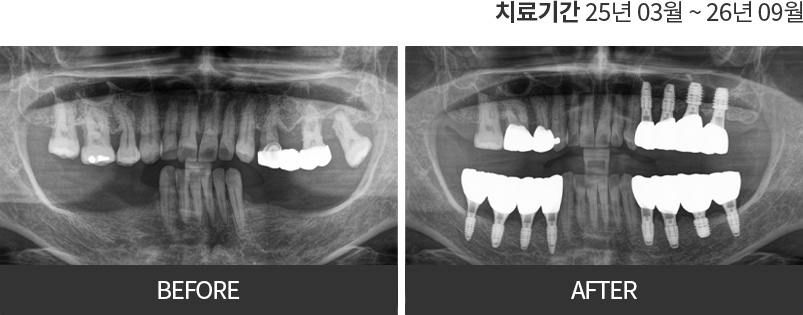 임플란트 치료 전후 사진 1