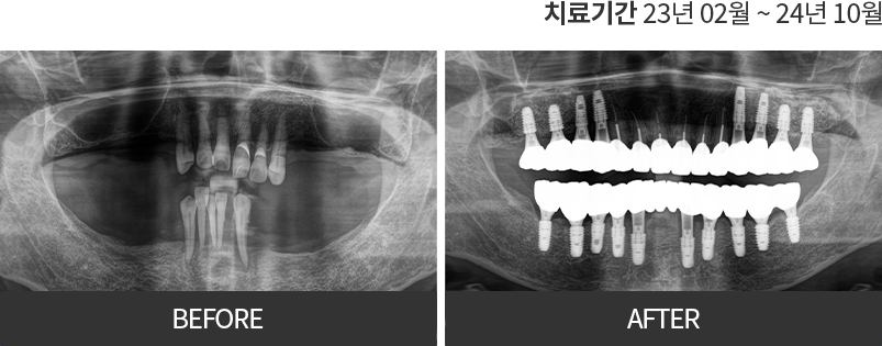임플란트 치료 전후 사진 6