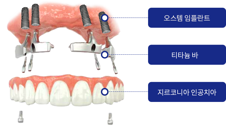 전체 임플란트 구조 — 오스템 임플란트, 티타늄 바, 지르코니아 인공치아